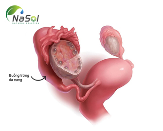 Cơ chế tác dụng của D-Chiro-inositol trên buồng trứng đa nang