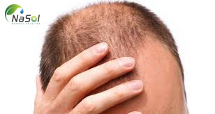 Giúp hạn chế chứng rụng tóc